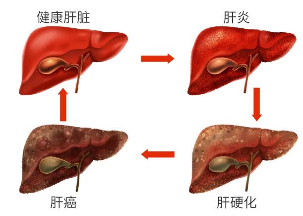 非酒精性脂肪肝吃什么中成药治疗？快来get